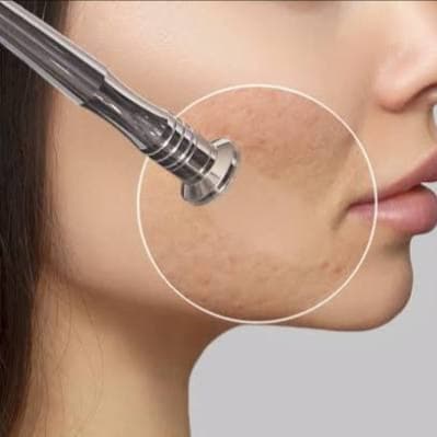 Mukha Soundarya (Microdermabrasion) at Kerala Ayurveda Panchakarma Center LLC in brandon, FL